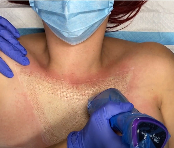 Treating Large Areas with the Aurorae Plasma Device - The Decolletage