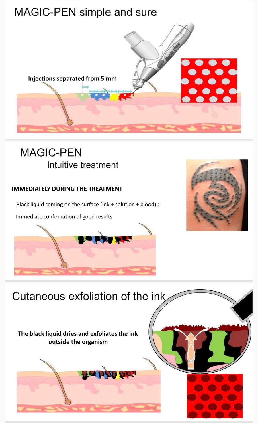 Professional Laser Picosecond Pen Tattoo Removal Laser Pen Blue&Red LED  Light Freckle Acne Mole Dark Spot Pigment Beauty Machine - AliExpress
