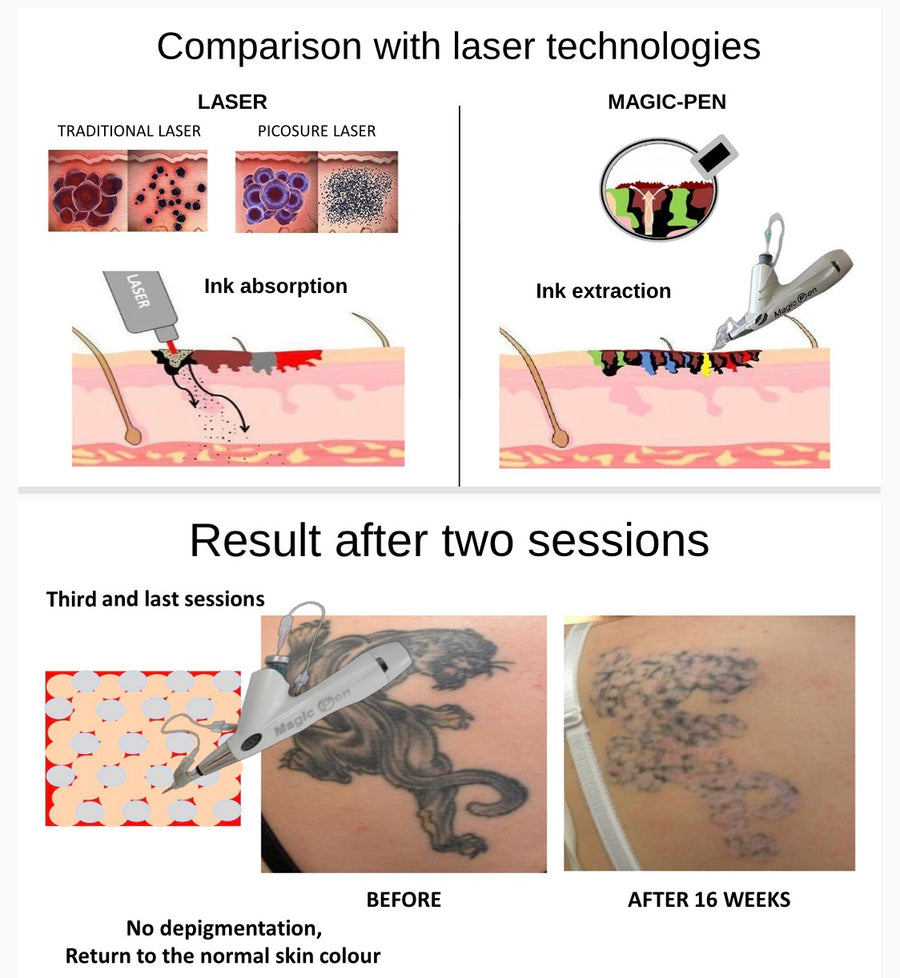 Picosecond Skin Laser Beauty Machine Tattoo/Spot Removal Pigment Pen  Portable | eBay